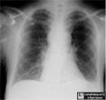 Esophageal Duplication Cyst